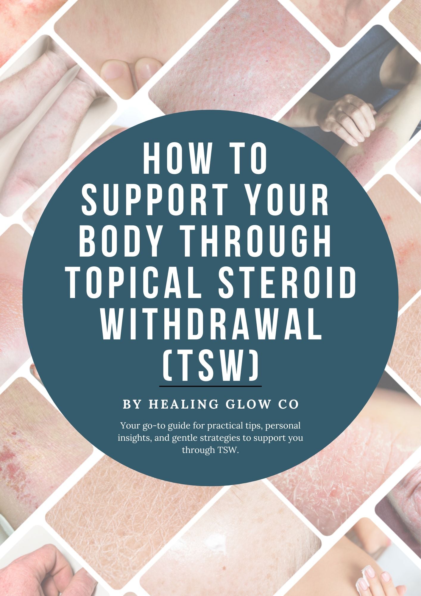 How to Support Your Body Through Topical Steroid Withdrawal (TSW)